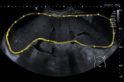 massive Splenomegalie bei homogenem Parenchym ohne isolierte Herdbefunde