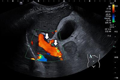 Orthograde Perfusion der Pfortader